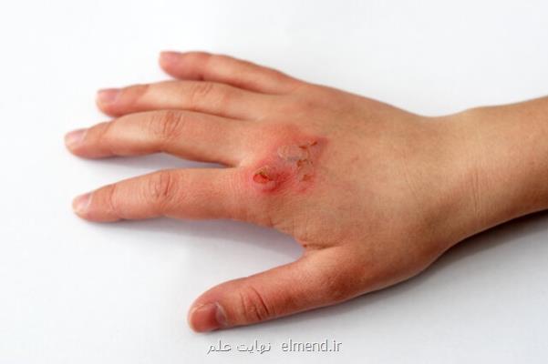 تشخیص زودهنگام عفونت زخم با کمک سنسورهای کم هزینه