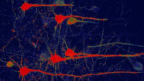 درمان نابینایی ناشی از سکته مغزی با ژن درمانی جدید