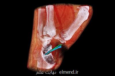 اسكنر اشعه ایكس رنگی سه بعدی از رگ ها عكس می گیرد